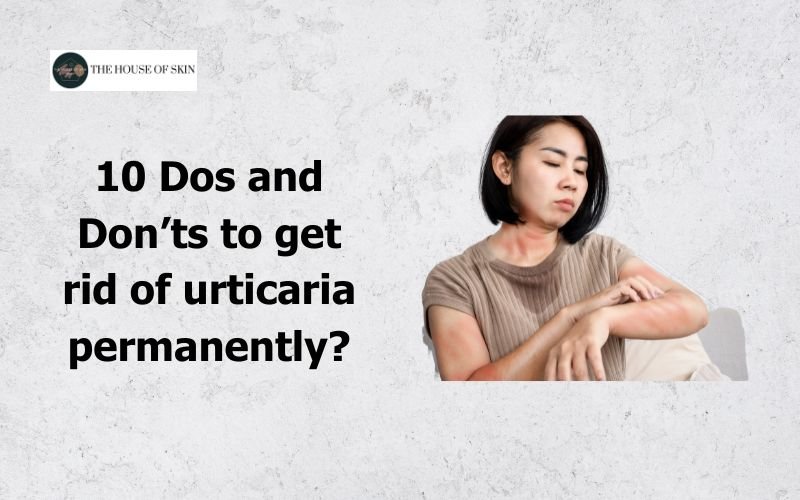 10 Dos and Don’ts to get rid of urticaria permanently