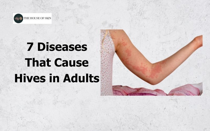 7 Diseases That Cause Hives in Adults