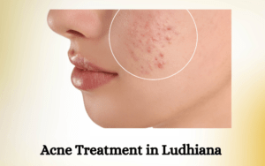 Acne Treatment in Ludhiana