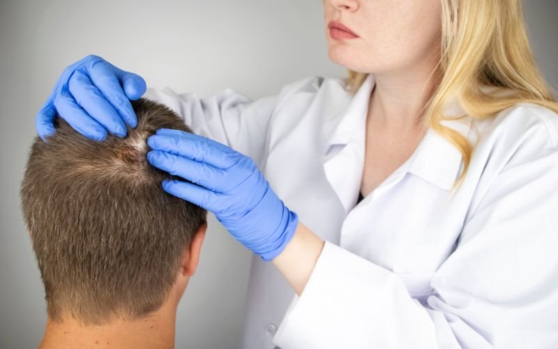 Alopecia Areata Treatment