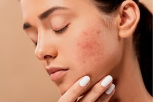 acne scar treatment in ludhiana