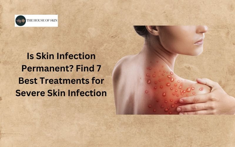 Is Skin Infection Permanent Find 7 Best Treatments for Severe Skin Infection