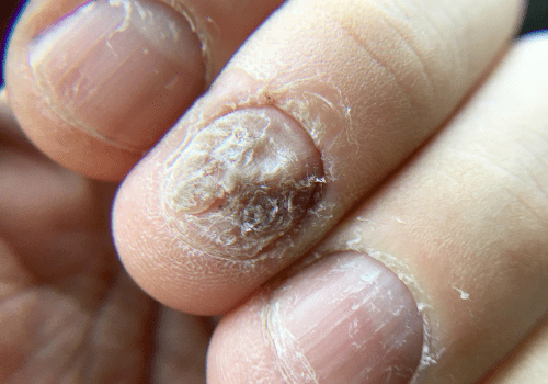 Nail Infections